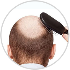 diffúz alopecia